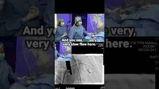 Choosing the Right Device for Challenging LAA Anatomy