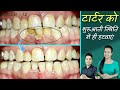 teeth cleaning tartar removal in hindi | tartar removal dentist | दांतों की सफाई  Episode - 12