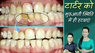 teeth cleaning tartar removal in hindi | tartar removal dentist | दांतों की सफाई  Episode - 12