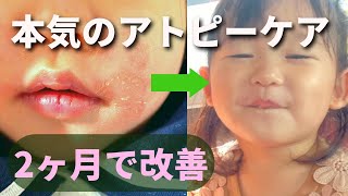 【子どものアトピー】原因とスキンケア