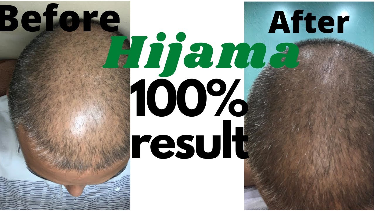Best way to stop hair fall | Honest feedback of patient | Hijama cupping  therapy at delhi Gurgaon - YouTube