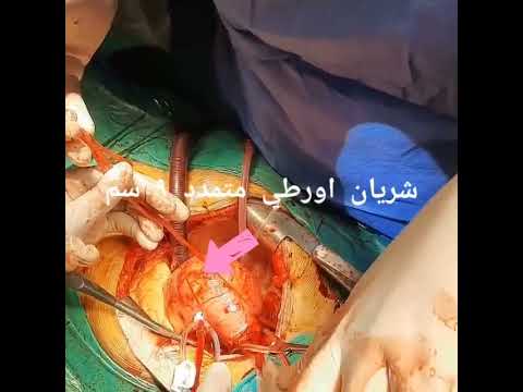 استبدال شريان أورطي متمدد ٩سم برقعة و انبوب صناعي