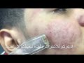 تنظيف البشره من الدهون بأجهزه شفط حديثه خاصه بالتجميل