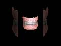 Los #BracketsAutoligables funcionan sin gomas gracias a un pequeño clip integrado que sujeta el arco