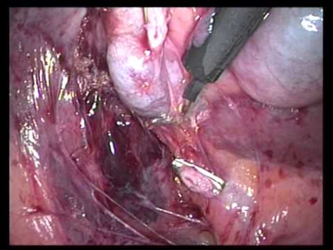 Laparoscopic Cholecystectomy (unedited-18)-In A Patient With Previous Upper Abdominal Surgery