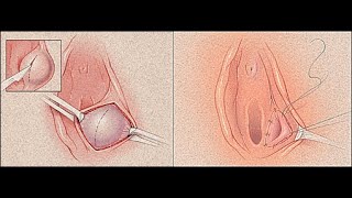 Bartholin Cyst آموزش تخلیه کیست غدد بارتولن در زنان