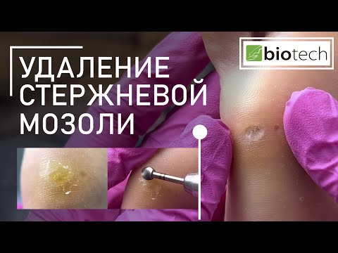 УДАЛЕНИЕ СТЕРЖНЕВОЙ МОЗОЛИ/ИСПОЛЬЗОВАНИЕ КЕРАТОЛИТИКА ПРИ УДАЛЕНИИ МОЗОЛЕЙ