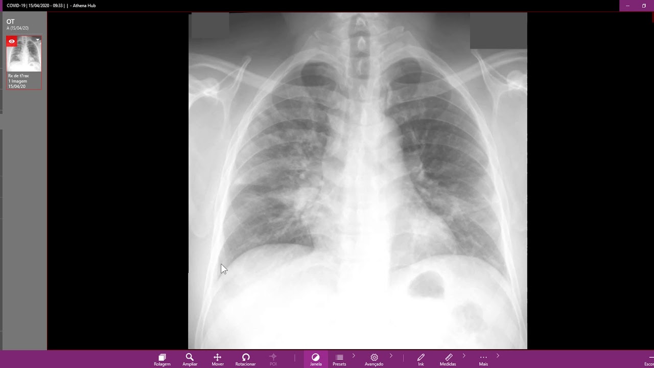 Rx de tórax COVID 19 - YouTube