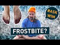 How to deal with frostbite  askwim