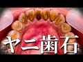 ヤニ歯石【歯石除去】Tartar and Tobacco tar  removal