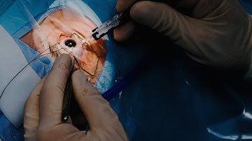 Clear Cornea Cataract Extraction and Insertion of Intraocular Lens by Erick D. Bothun, MD | Preview