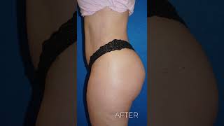 Brazilian Butt Lift (BBL) results