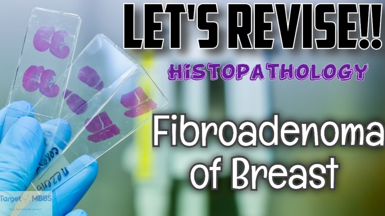 HISTOPATHOLOGY | FIBROADENOMA OF BREAST | Target MBBS | PATHOLOGY ...