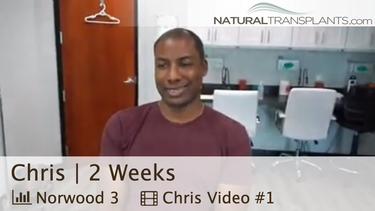 fue hair transplant month by month Hair Transplant After 14 Days | Hair Transplant Doctor Harold Siegel (Chris)