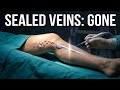 Endovenous Laser Treatment: How Laser Seals Off Varicose Veins