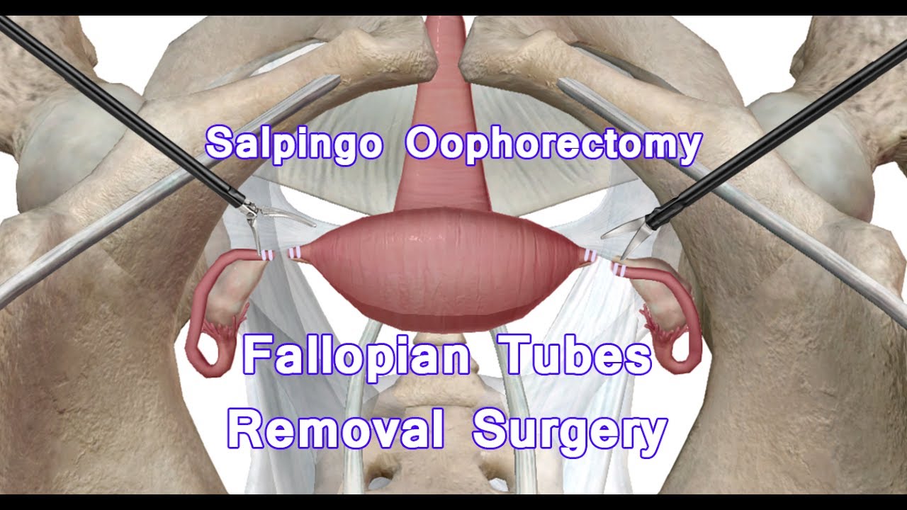 oophorectomy salpingo bilateral laparoscopic ovary