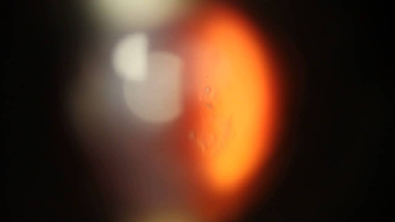 Floaters Vitreolysis Floater removal with the Ellex YAG Laser performed by Dr. Paul Singh