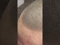 Close up of scalp Micropigmentation right after treatment #shorts #scalpmicropigmentation #hairtatto