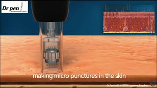 How Dr.Pen Microneedling Improves stretch marks and acne scars  (Collagen Induction Therapy)