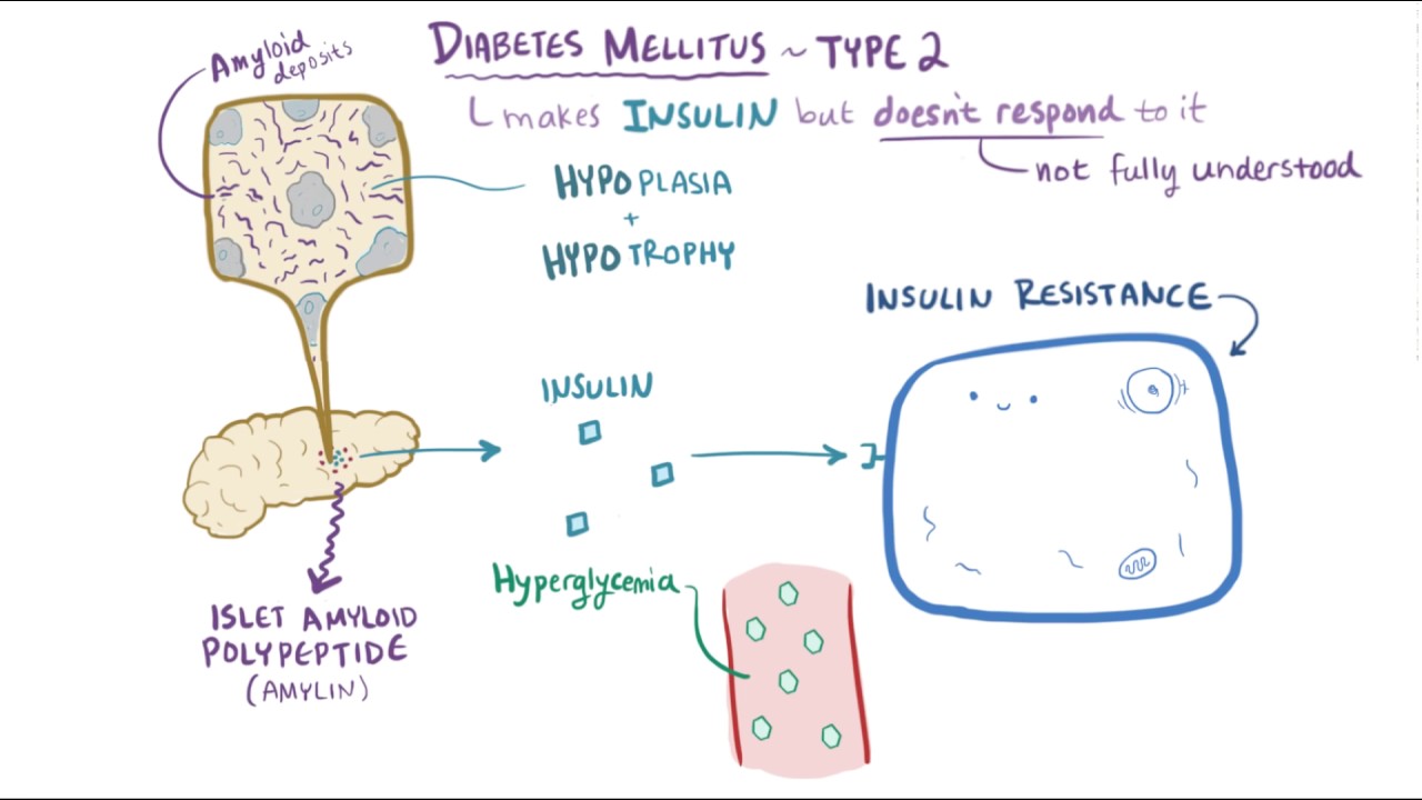 ketoacidosis diabetes mellitus 1 típusú kezelési protokoll