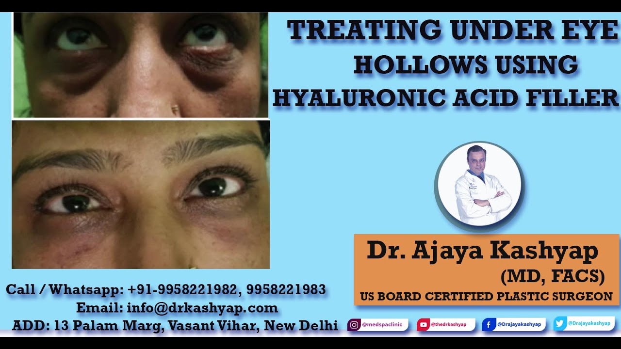 Treating Under Eye Hollows Using Hyaluronic Acid Filler by Dr. Kashyap