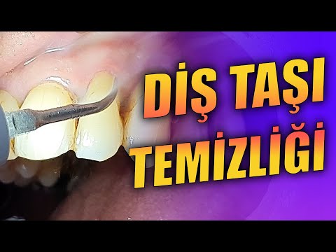 Diş Taşı Temizliği ve Kök Yüzeyi Düzleştirmesi