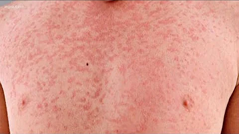 Stalled Vaccine Bill Finally Out Of Committee