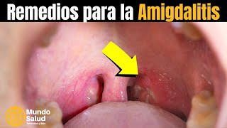🔴✅ 4 HOME REMEDIES FOR TONSILLITIS YOU PROBABLY DIDN'T KNOW - MUNDO SALUD