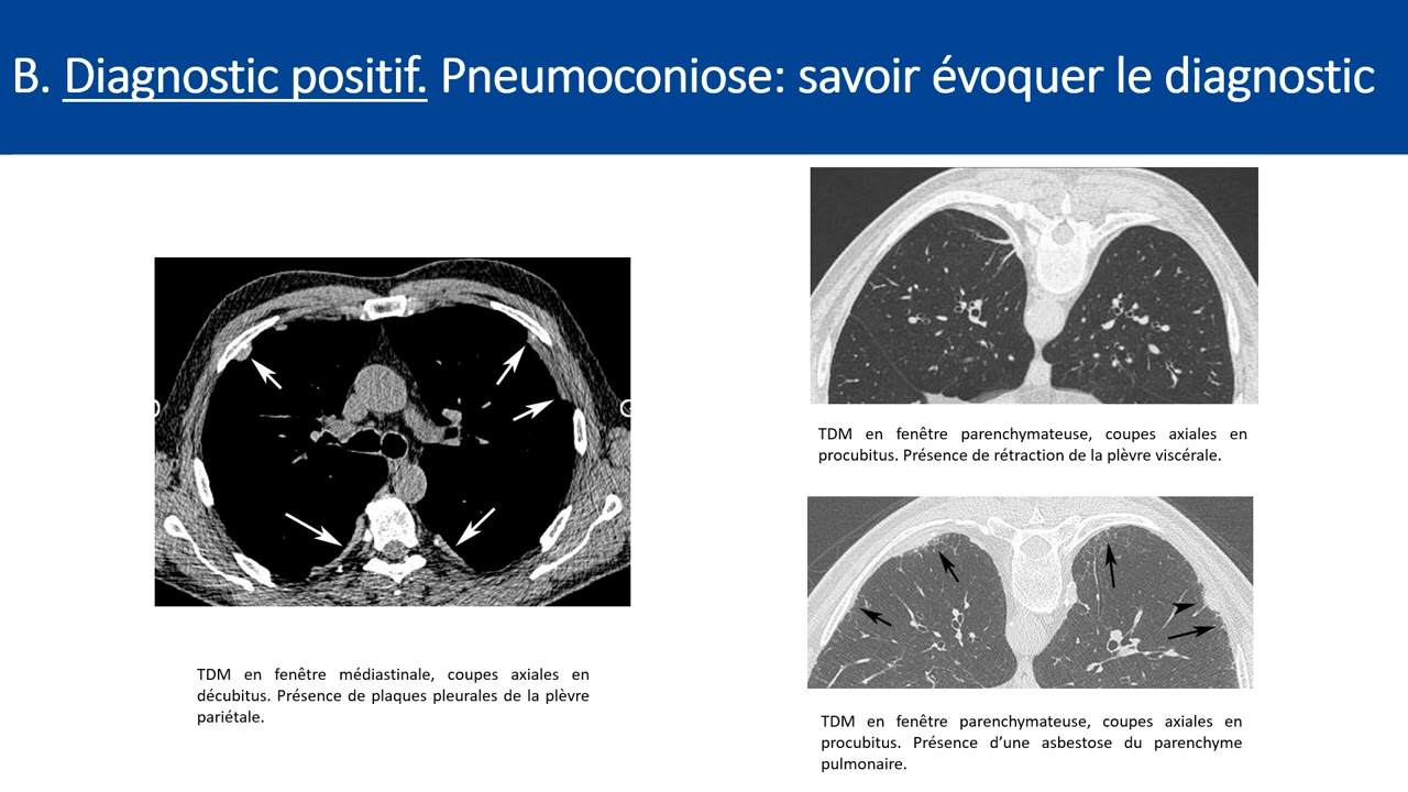 Item 210 Pneumopathie infiltrante diffuse
