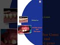 🦷🚫 Don't Ignore Your Gums! Learn About Gum Disease Symptoms 🚫🦷
