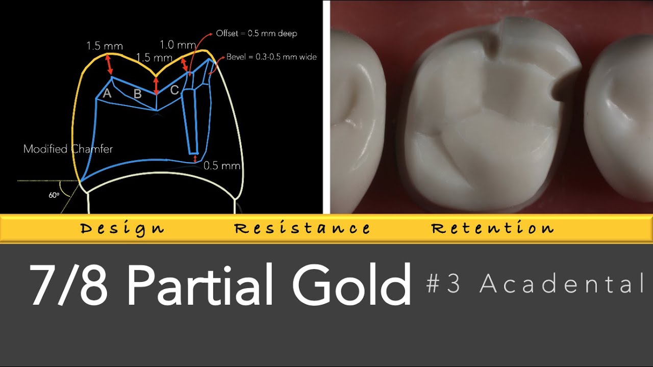 7/8 Gold Partial Veneer 3 Acadental Gold Coverage Restoration YouTube