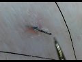 Ingrown Hair 埋没毛の救出!PART6