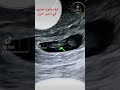 كيف يكون الجنين في الشهر الاول Viral Explore حامل في الشهر الاول الجنين في الشهر الثاني الحامل