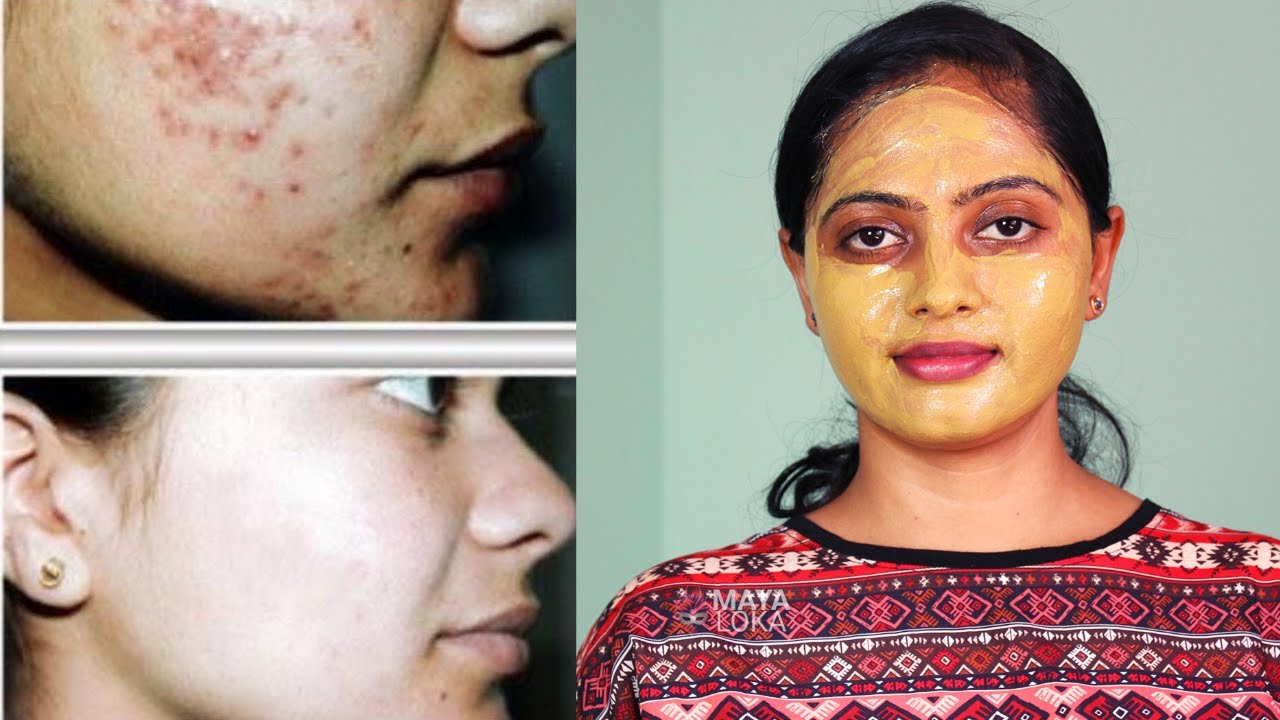 ಪಿಂಪಲ್ಸ್ ಮತ್ತು ಪಿಂಪಲ್ ಕಲೆಗಳು ಇದೆಯಾ? । Remove PIMPLES, ACNE, DARK SPOT instantly with Multani mitti