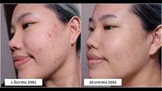 ใช้อะไร ทำไมรอยสิวถึงหาย!! | Baroctar