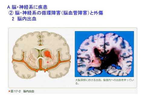 Web講義病理学大14回（第17章脳・神経・筋肉系の疾患）（20220120）