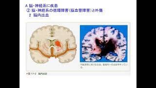 Web講義病理学大14回（第17章脳・神経・筋肉系の疾患）（20220120）
