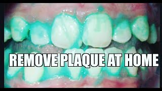 Plaque when it hardens becomes tarter so is important to brush away
every time. the problem you cannot see but can now. remove plaque...