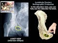 Acetabular Fracture Radiographic Evaluation - Everything You Need To Know - Dr. Nabil Ebraheim