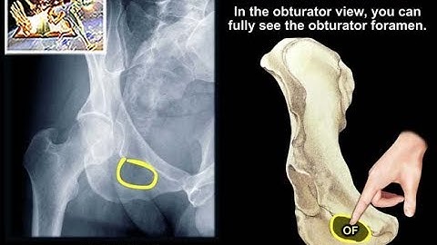 Acetabular Fracture Radiographic Evaluation - Everything You Need To Know - Dr. Nabil Ebraheim