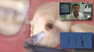 Glass fiber post removal