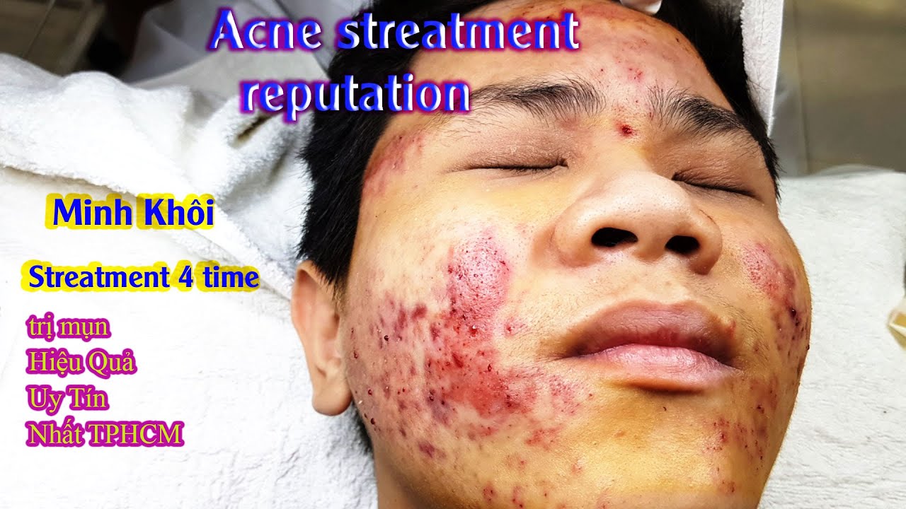 Cách Điều Trị Mụn Viêm, Hiệu Quả Nhất TPHCM Tại Hiền... - youtube