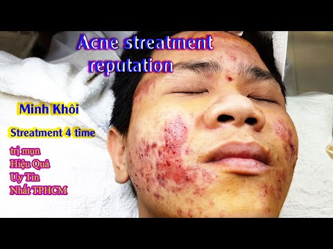 Video Cách Điều Trị Mụn Viêm, Hiệu Quả Nhất TPHCM Tại Hiền... - youtube