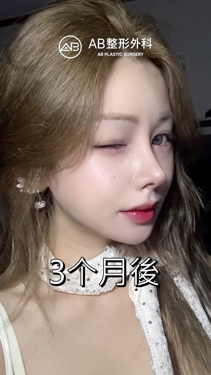 術後變化太誇張，直接變女神 #shorts