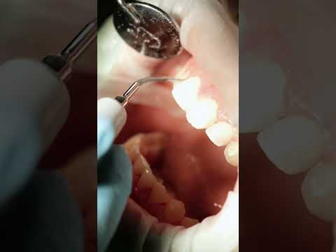 Видео: АСМР чистка зубов