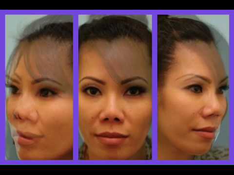 3-Way Morph for Asian Blepharoplasty, Revision Rhinoplasty, Fat Grafting