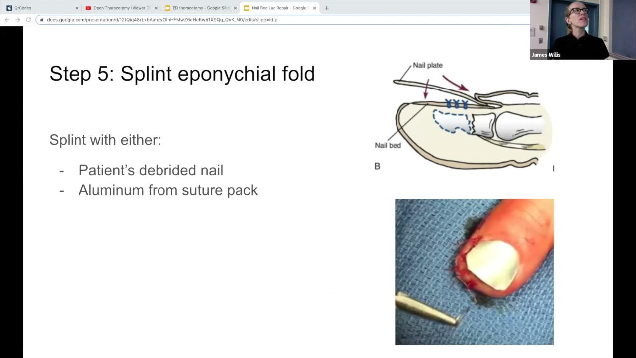 Dr. Anthony "Nail Bed Laceration Repairs" YouTube