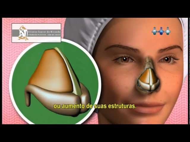 Que nariz é esse!!! Vídeo completo: Esses jogos de cirurgia