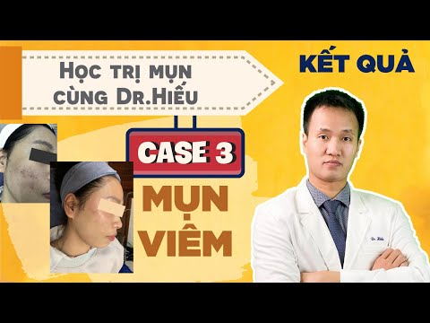 [HỌC TRỊ MỤN CÙNG DR.HIẾU] Kết quả case 3: Mụn viêm va mụn ẩn hỗn hợp | Dr Hiếu