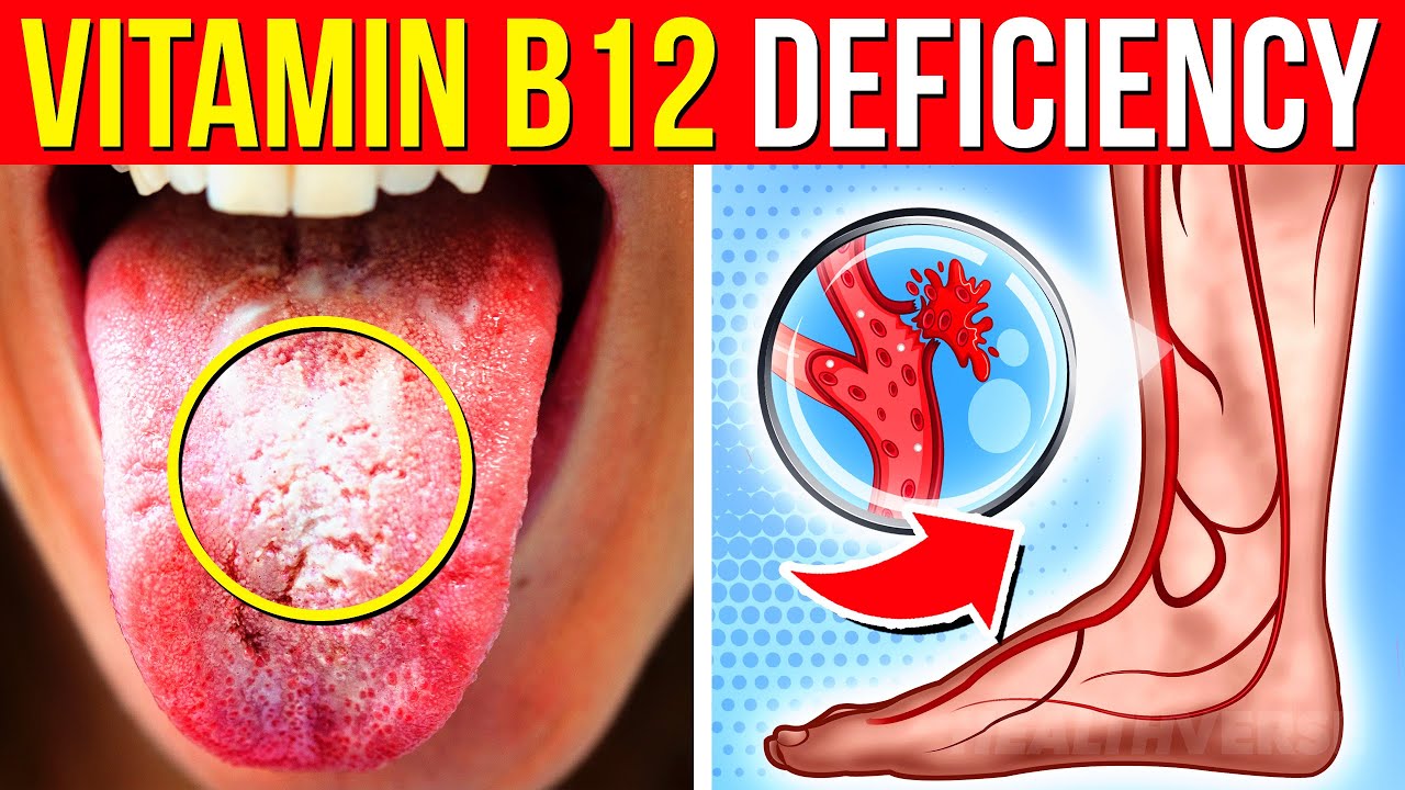 9 Vitamin B12 DEFICIENCY Warning Signs You Must Never Ignore